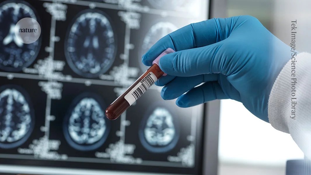 صورة مميزة: ما مدى شيوع مرض الزهايمر؟ دراسة اختبار الدم تحمل مفاجآت